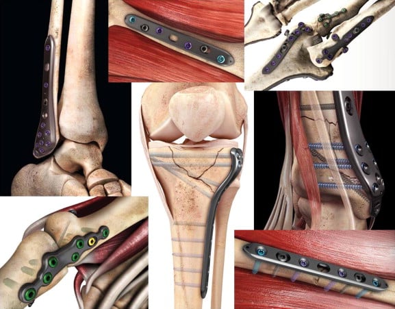 Use-of-Composite-Materials-in-the-Medical-Industry